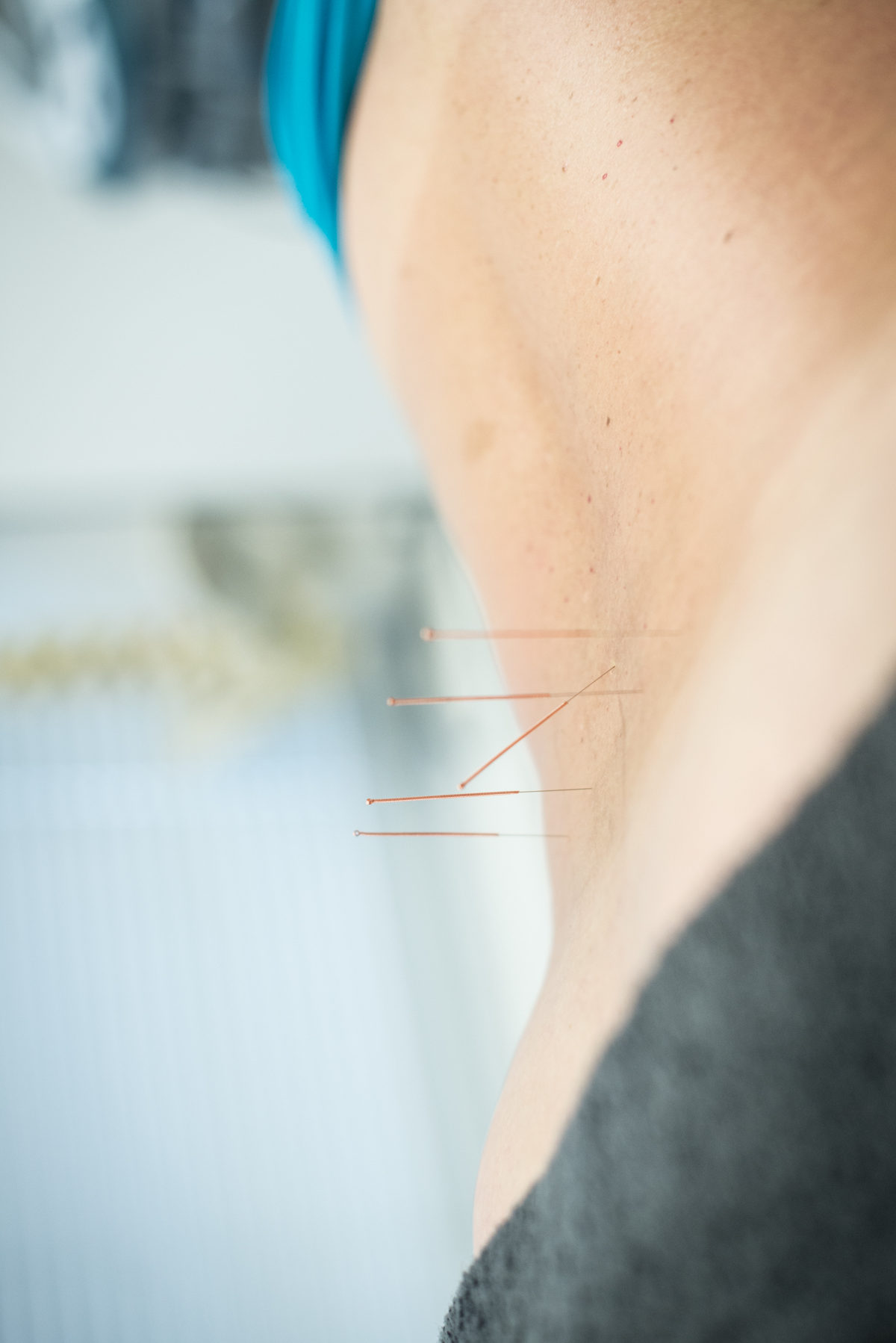 Acupuncture lower back